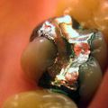 Amalgame dentaire toxique / Dévitalisation mortelle