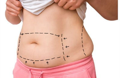 Questions et réponses sur l'abdominoplastie