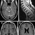 EVOLUTION OF MULTIPLE SCLEROSIS IN FRANCE SINCE THE BIGINNING OF HEPATITIS B VACCINATION BY DR LE HOUEZEC DOMINIQUE