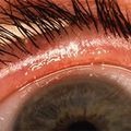 A Stepwise Approach To Acute Dry Eye 