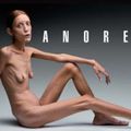 QCM sur les dangers de l'anorexie sur internet