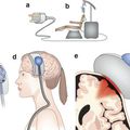 Estimulación transcraneal