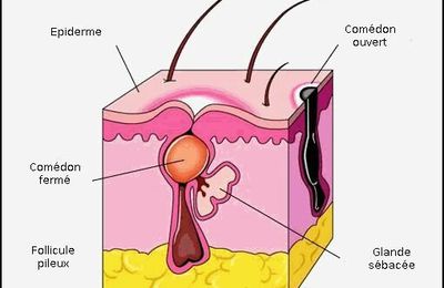 Qu'est-ce que l'acné ?