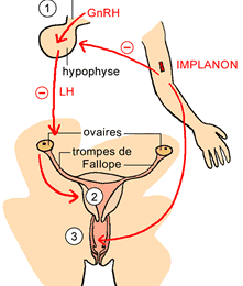 Les méthodes de contraceptions valables plusieures années