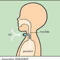 Et c'est parti pour apprendre à vivre avec une trachéotomie !