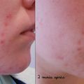 Roaccutane/ Curacné - 2 mois après