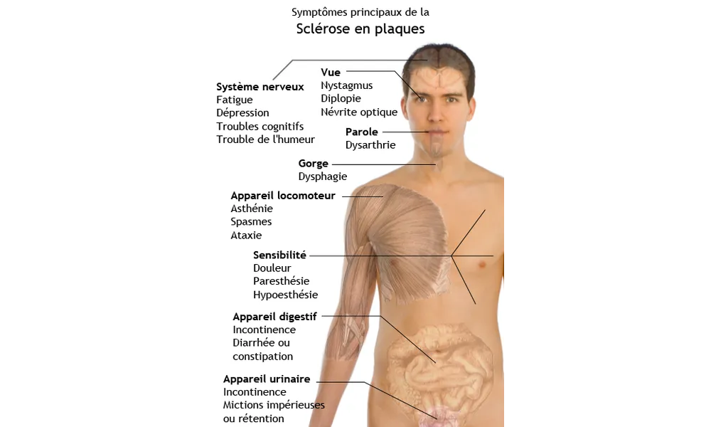 La SEP pour tous 3 - les symptomes