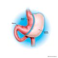 SLEEVE GASTRECTOMY