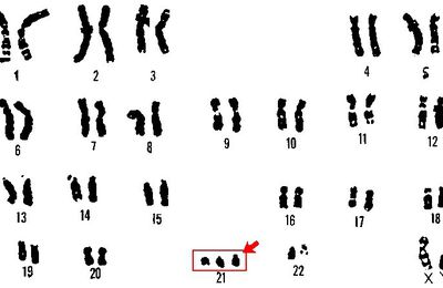 Santé mentale : In vitro, des chercheurs réduisent la trisomie 21 au silence !