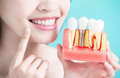 Comment choisir un implant dentaire ?