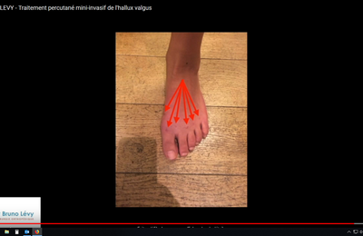 hallux valgus (oignon)