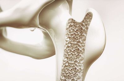 Prévenir l'ostéoporose, c'est possible