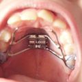 fin de l'orthodontie