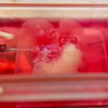 Transplantation de mini foies humains