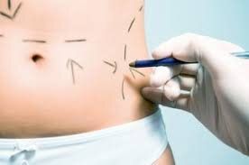 Liposuccion : chirurgie et complications