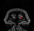 Fibromyalgie et neuro-imagerie cérébrale
