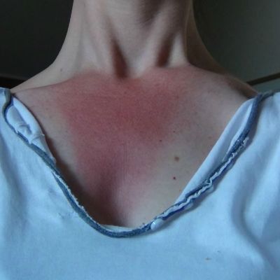 "J'ai attrapé un coup d'soleil..."