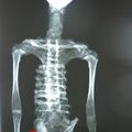 Alberto, greffe osseuse et prothèse de hanche