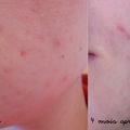 Roaccutane/Curacné - 4ème mois