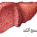 HEPATITE VIRALE Cا لتهاب الكبد "س"