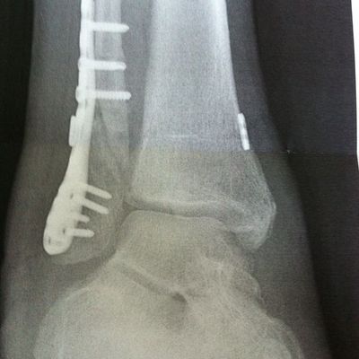 Fehlstelung verheilte Fibula Reoperation: 06.05.2011