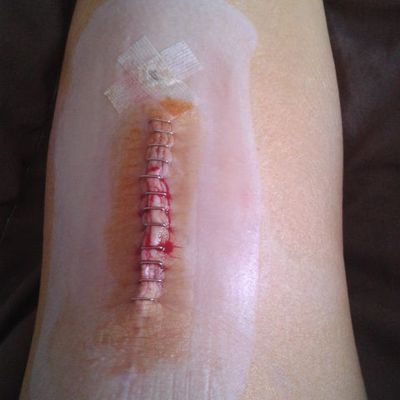 Ablation des vis à gauche.