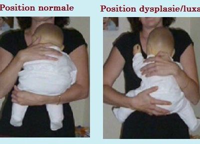portage et dysplasie ou luxation de la hanche