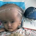 Chine : un bébé malformé reçoit un crâne en titane imprimé en 3D