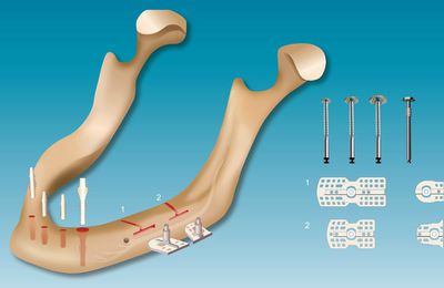 Implants dentaire PEEK sans greffe d'os / SisoMM