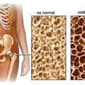 Petite histoire de l'ostéoporose