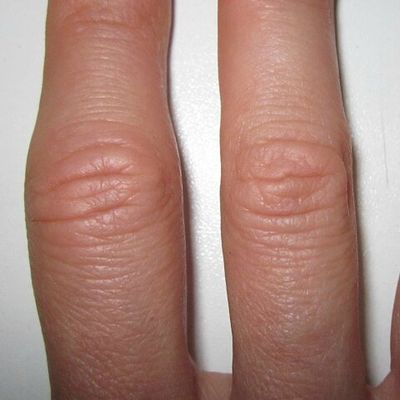 Les plantes pour lutter contre l’arthrite