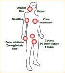 Maladie de Verneuil (Hidradénite suppurée)