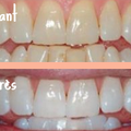 [DIY] Pour des dents blanches !