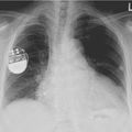 Information très importante : Les pacemakers possèdent des alarmes