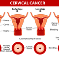 9 SIGNES PRÉCURSEURS MAJEURS DE CANCER DU COL UTÉRIN QUE VOUS DEVEZ SAVOIR