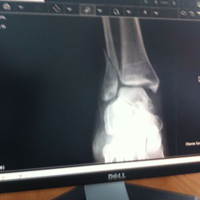  Fracture du perronet / Fibula Fraktur Radologie du / von 29.12.2010- 11.04.2011