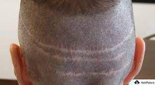 Cicatrice : Greffe de cheveux ou excision ?
