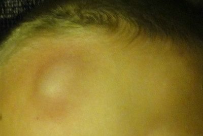 Pourquoi a t-on une bosse quand on se cogne?