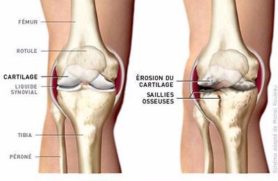 L'arthrose en quelques mots