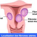 Comment traiter efficacement le fibrome sans la chirurgie 