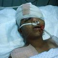 Cas urgent: Mahmoud, 11 ans, blessé au visage par un sniper israélien à Gaza