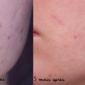 Roaccutane/Curacné - 5 mois après