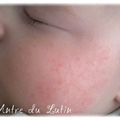 DIY: Soin Anti Eczéma pour Bébé