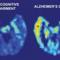 Alzheimer: du nouveau?