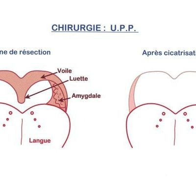 L'uvulo-palato-pharyngoplastie (UPP)