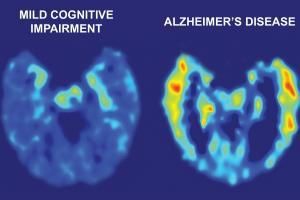 Alzheimer: du nouveau?