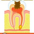 Top 15 Home Remedies For Cavities