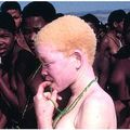 LA MALADIE ALBINOS