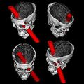 Le fabuleux cas de Phineas Gage