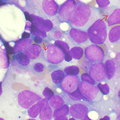  Classification de la leucémie aiguë myéloblastique